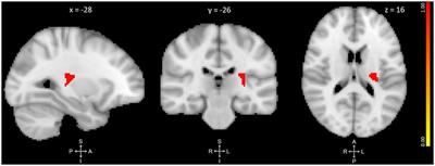 Gray Matter Changes in Adolescents Participating in a Meditation Training